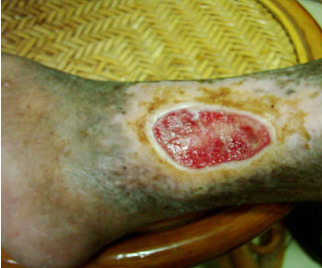 diabetic ulcer picture 2