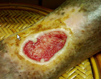 diabetic ulcer picture 3