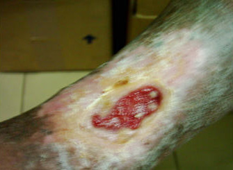 diabetic ulcer picture 4