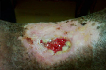 diabetic ulcer picture 5