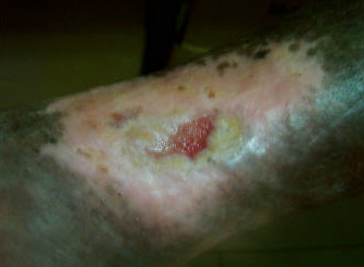 ulcer picture 6