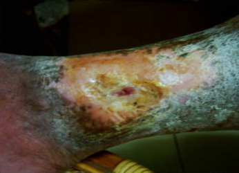 diabetic ulcer picture 7