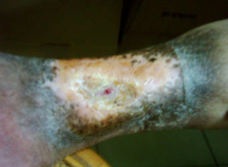 ulcer picture 8